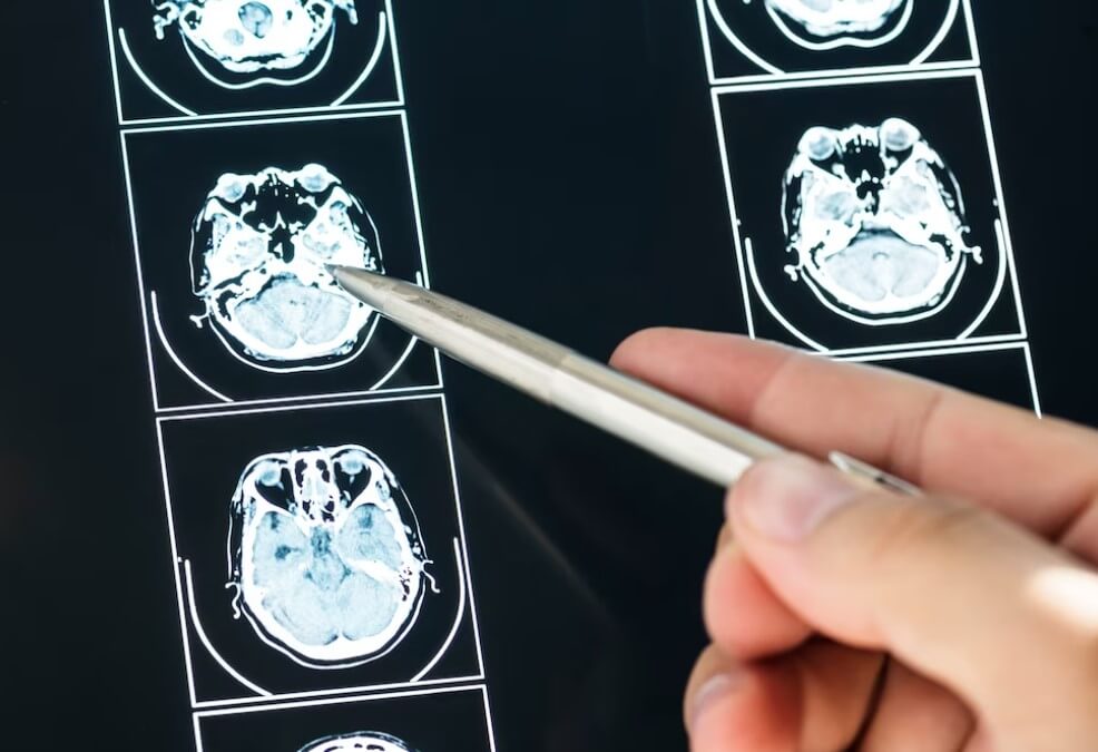 CBD Oil For Multiple Sclerosis Research Image