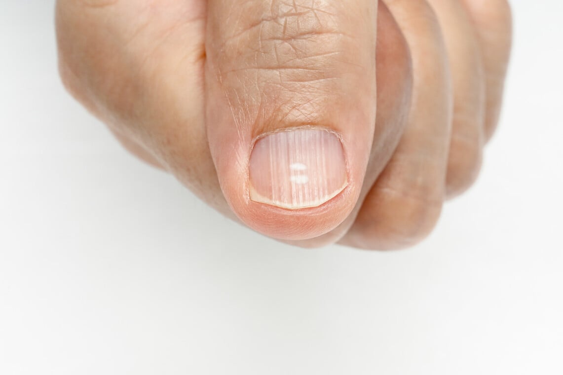 Appearance of streaked nails and vitamin deficiency