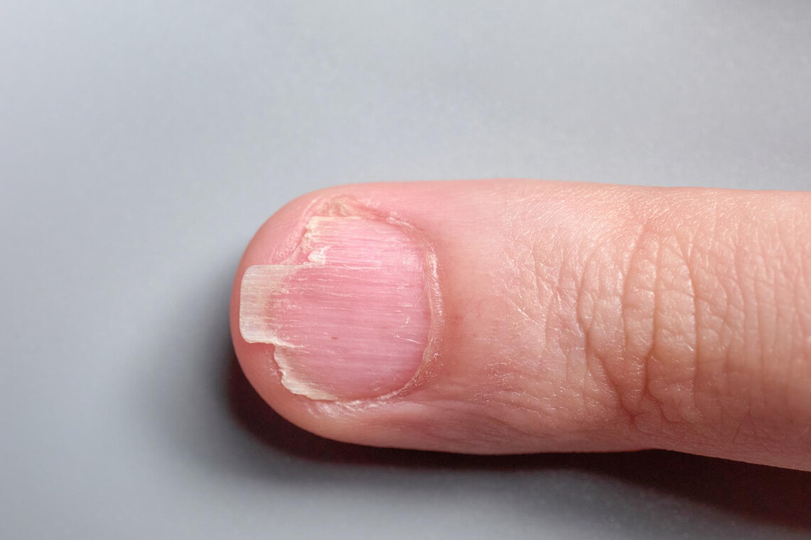 Soft and brittle nails are not a pleasant sight