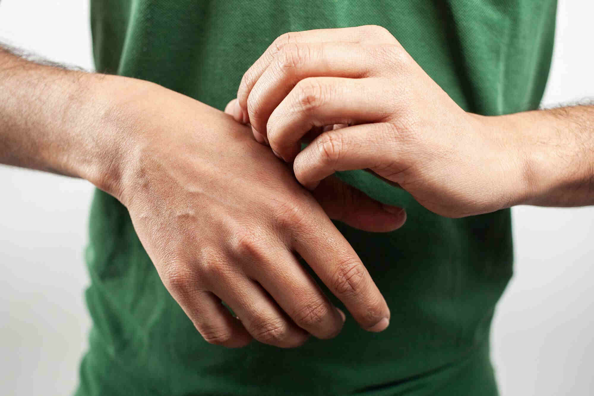 dry eczematous skin on the hand