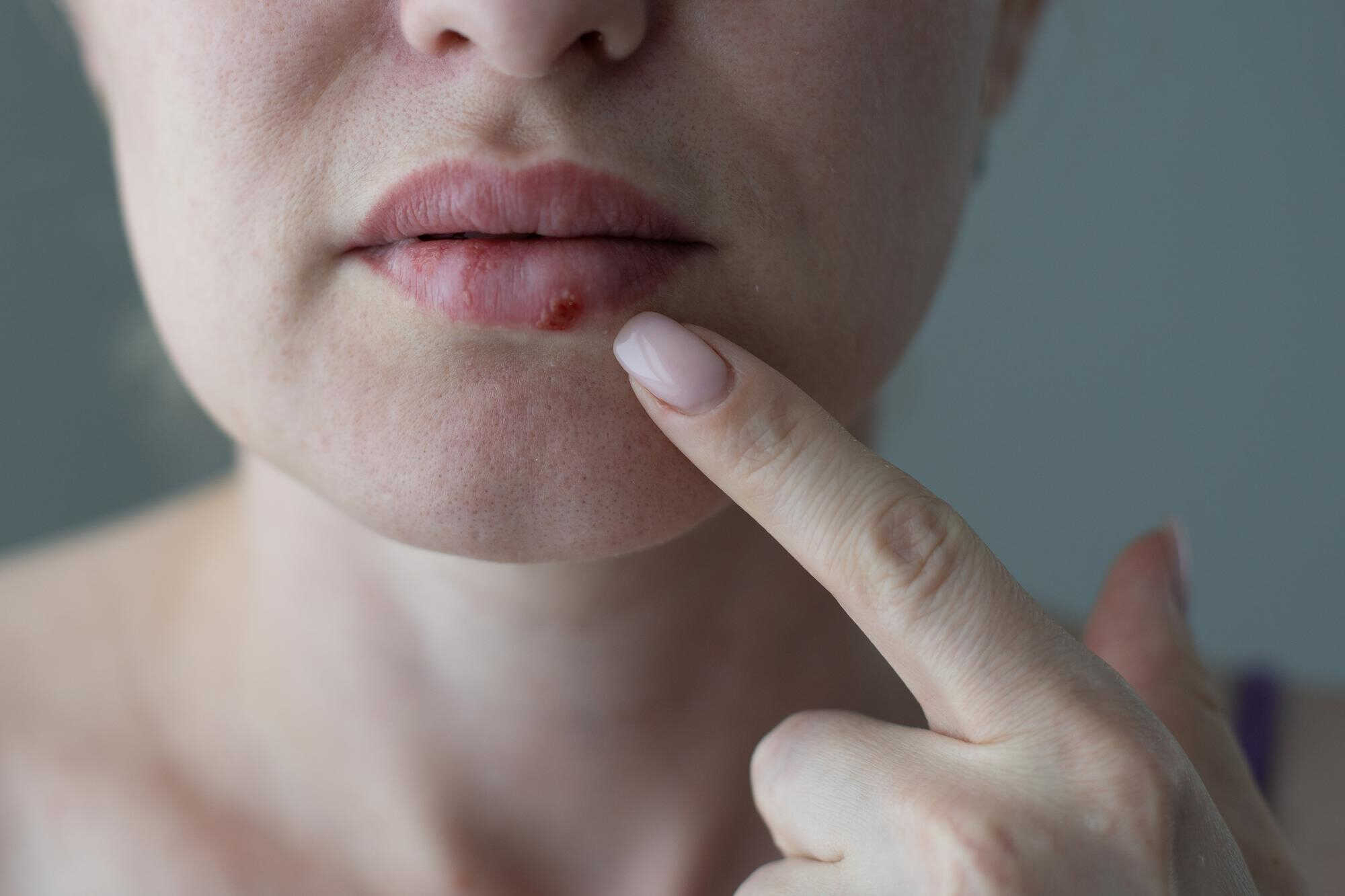how to clear herpes in 1 day
