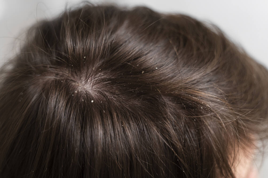 Flaky scalp is not a pleasant sight