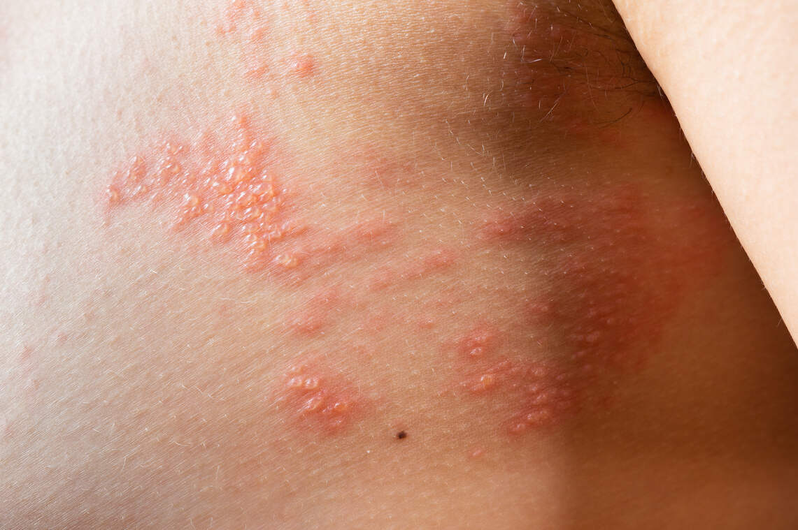 Herpes on skin