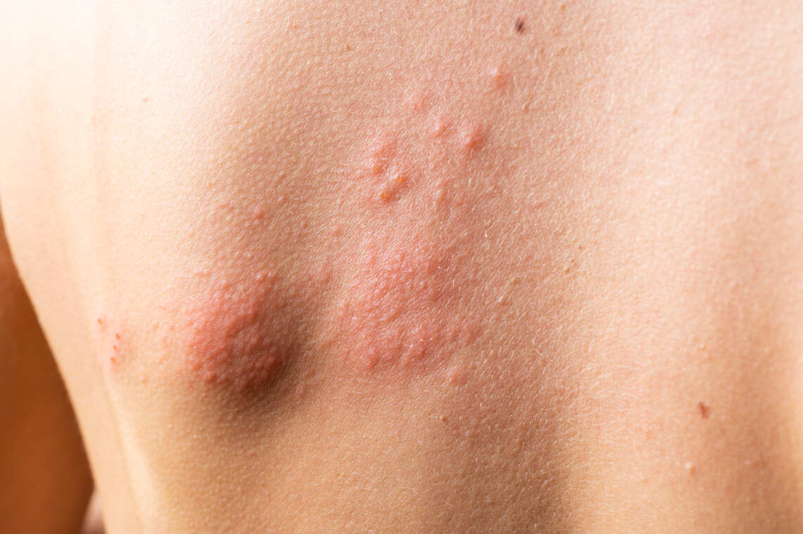Prevention of herpetic skin inflammation