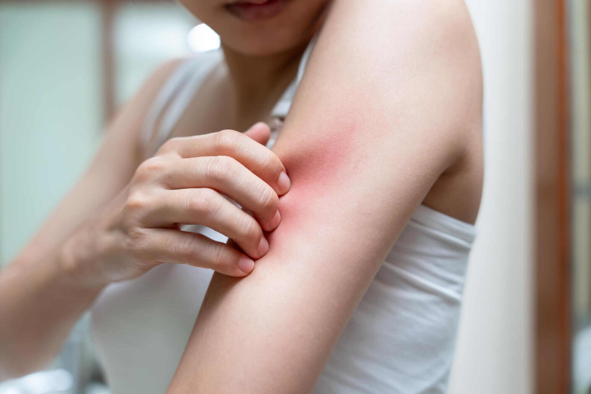 itchy eczema appearing on the arm